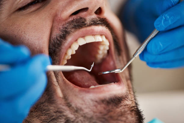 Emergency Dental Filling Replacement in WI